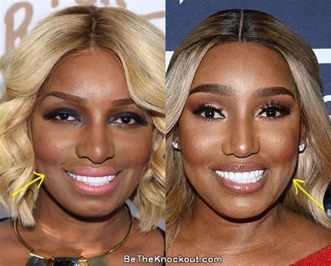 nene leaks before surgery|Complete Details of Every NeNe Leakes Plastic Surgery